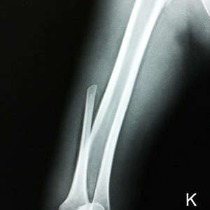 Black and white x-ray of a broken leg bone with a letter K in the bottom right corner. 