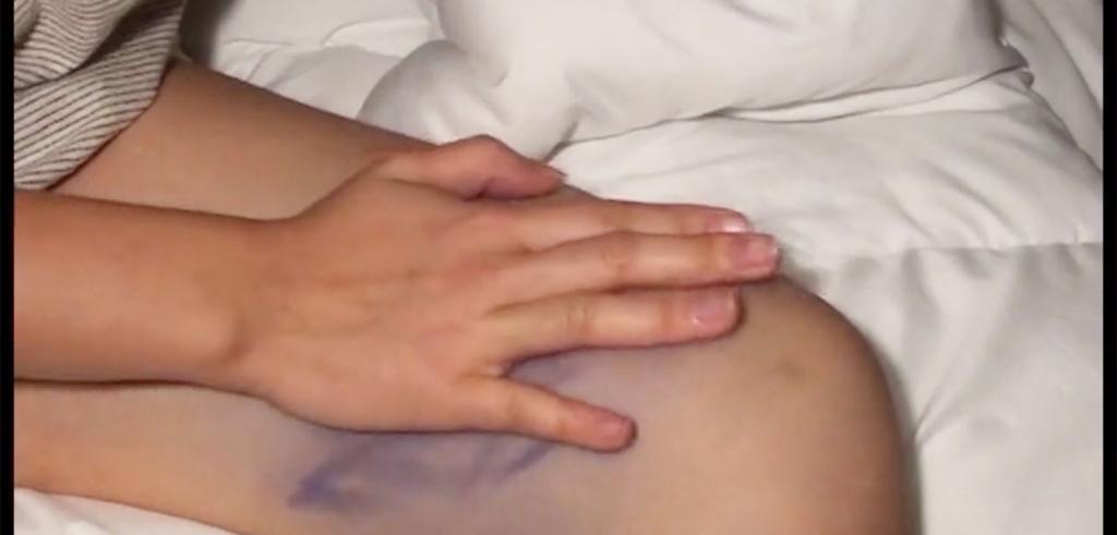 Video still of someone showing their thigh with dark purple marks on it with their hand partially covering it against a white comforter.